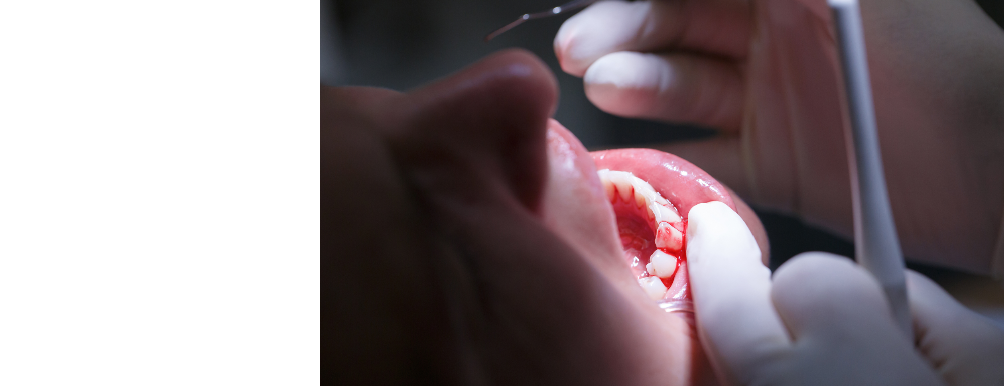 Dental Emergency Tooele UT