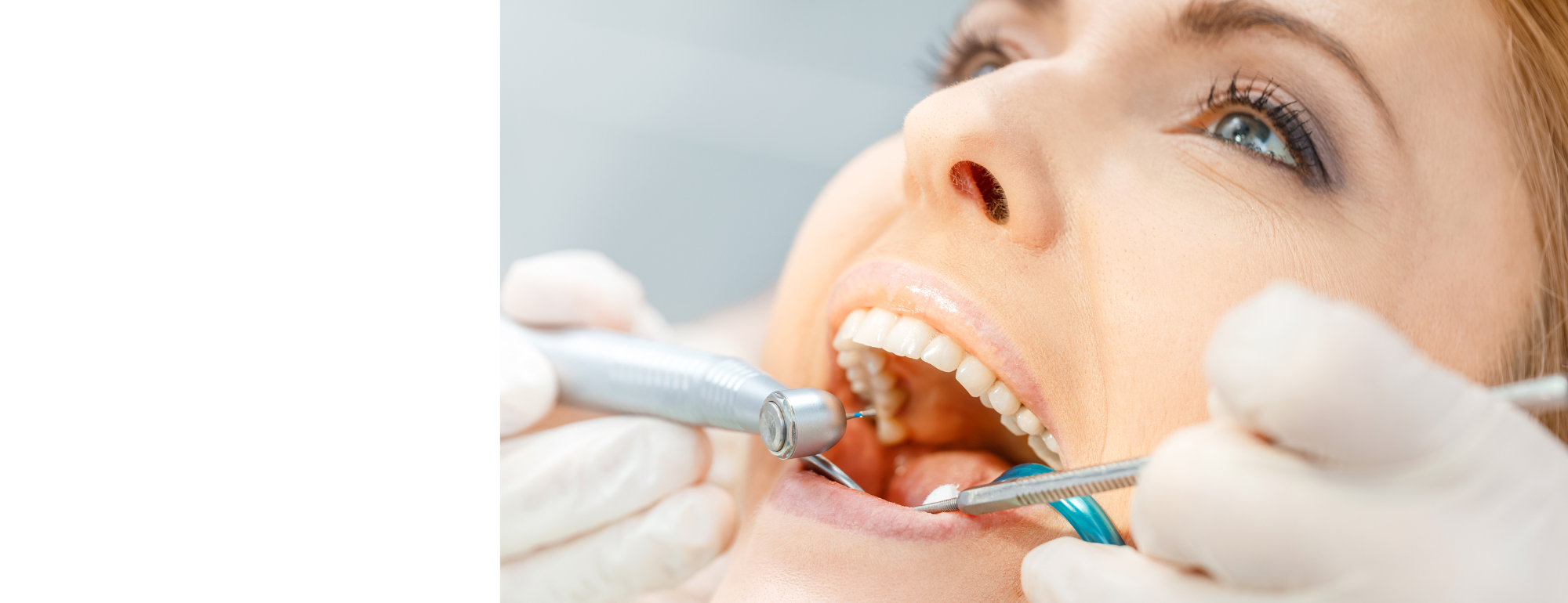 Dental Filling Tooele UT