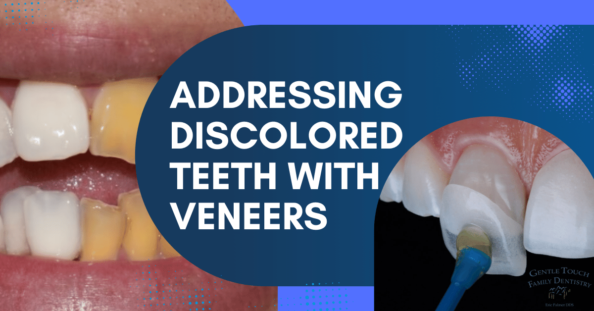 Addressing Discolored Teeth with Veneers