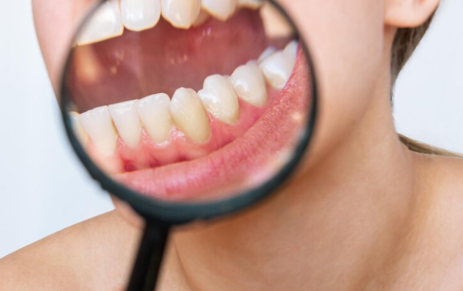 Check your teeth - Dental Erosion