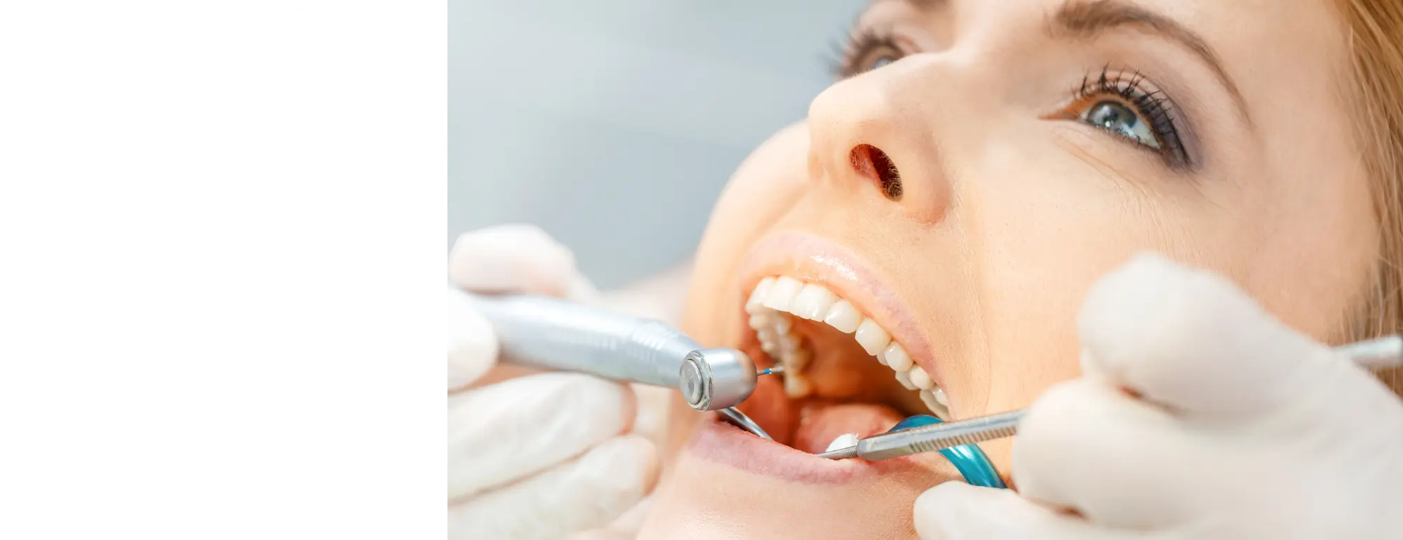 dental filing