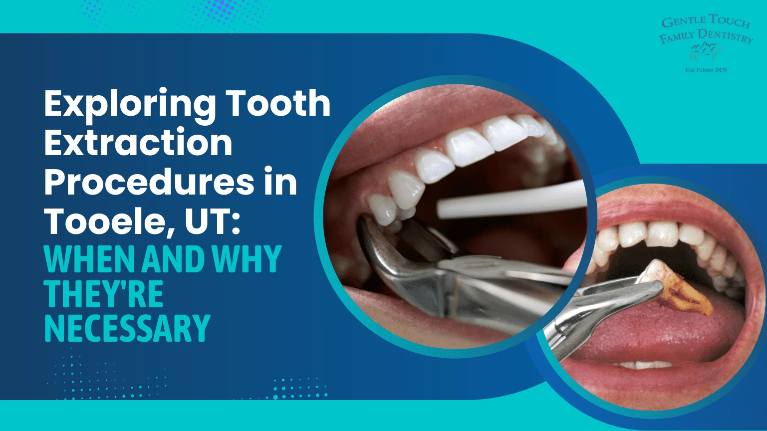 Exploring Tooth Extraction Procedures in Tooele, UT When and Why They're Necessary