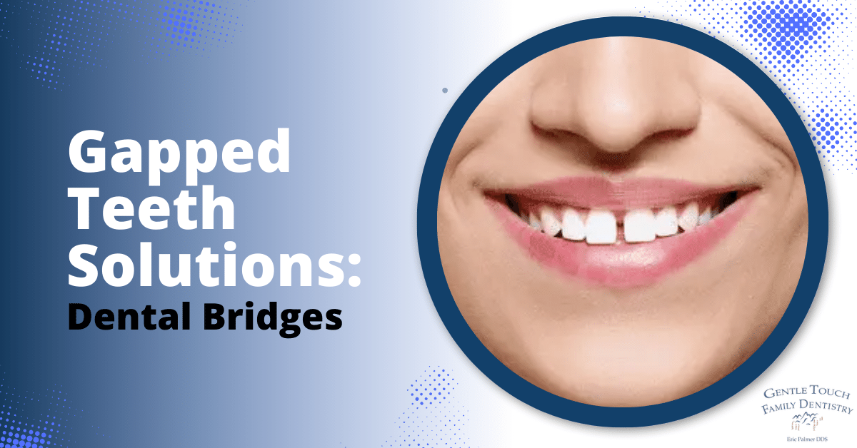 Gapped Teeth Solutions Dental Bridges