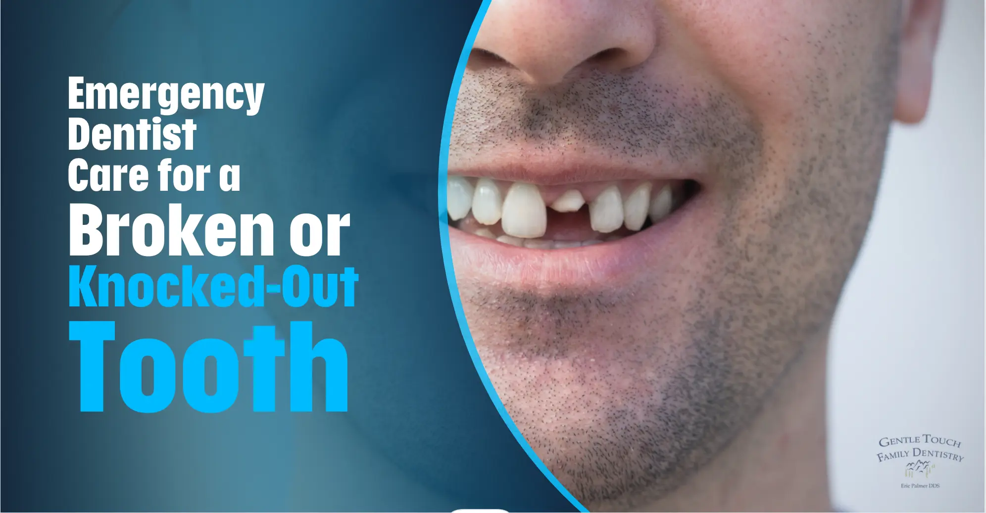 Emergency Dentist Care for a Broken or Knocked-Out Tooth