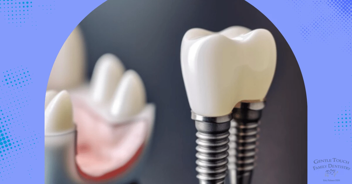 Transform Your Smile Unmatched Dental Implants Services in Tooele UT